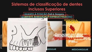 Sistemas de classificação de dentes
inclusos Superiores
 Natureza do tecido de recobrimento
 Quanto à angulação
 Posição A, B e C de Pell & Gregory
QUANTO À ANGULAÇÃO MESIO-DISTAL
VERTICAL MESIOANGULARDISTOANGULAR
QUANTO À ANGULAÇÃO VESTIBULO-PALATINO
 Vestibular
 Palatino
QUANTO À POSIÇÃO Pell & Gregory
POSIÇÃO A
Plano oclusal do 3º Molar no
mesmo nível que o do 2º Molar
POSIÇÃO B
Plano oclusal do 3º Molar entre o
plano oclusal e a cervical do 2º
Molar
POSIÇÃO C
Plano oclusal do 3º Molar abaixo
do plano oclusal e a cervical do
2º Molar
(PETERSON,1998)
 