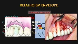 RETALHO EM ENVELOPE
INDICAÇÕES
Dentes inclusos
localizados próximos
à região cervical dos
dentes adjacentes
erupcionados.
CONTRA-INDICAÇÕES
 Dentes distantes da região
cervical dos dentes
adjacentes erupcionados
 Paciente de prótese fixa
CANINO INCLUSO
 