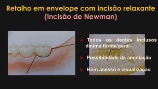 Retalho em envelope com incisão relaxante
(Incisão de Newman)
 Todos os dentes inclusos
deuma forma geral
 Possibilidade de ampliação
 Bom acesso e visualização
 