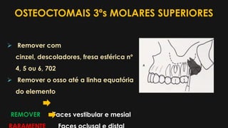 OSTEOCTOMAIS 3ºs MOLARES SUPERIORES
 Remover com
cinzel, descoladores, fresa esférica nº
4, 5 ou 6, 702
 Remover o osso até a linha equatória
do elemento
REMOVER Faces vestibular e mesial
 