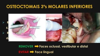 OSTEOCTOMAIS 3ºs MOLARES INFERIORES
 Remover com fresa esférica nº 4, 5 ou
6, 702
 Remover o osso até a linha equatorial
do elemento
REMOVER Faces oclusal, vestibular e distal
EVITAR Face lingual
 