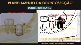 PLANEJAMENTO DA ODONTOSECÇÃO
INCLUSÃO VERTICAL
Seccionar e remover a
metade distal e depois o resto
do dente.
O acesso à volta do 2M é mais
difícil e requer uma remoção
maior de osso .
INCLUSÃO MESIOANGULAR
Seccionar e remover primeiro a
porção distal ou mesial e depois
o resto do dente
A odontossecção cria espaço entre o
terceiro molar e o ramo ascendente
INCLUSÃO DISTOANGULAR
 Raízes divergentes devem ser
seccionadas
 Requer grande osteoctomia
na porção distal
INCLUSÃO HORIZONTAL
1° Separação COROA-RAIZ
2 ° Remover a coroa e depois as
raízes
Se as raízes são divergentes separar
e remover individualmente.
DENTES INFERIORES
 