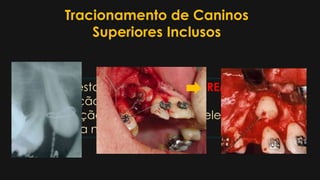 Tracionamento de Caninos
Superiores Inclusos
 Pode estar anquilosado REMOÇÃO
 Exposição do elemento
 Aplicação de dispositivo no elemento
 Amarria na aparatologia fixa
 