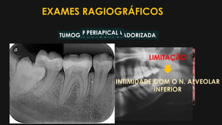 EXAMES RAGIOGRÁFICOS
TUMOGRAFIA COMPUTADORIZADAPANORÂMICAPERIAPICAL
LIMITAÇÃO
INTIMIDADE COM O N. ALVEOLAR
INFERIOR
 