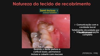 Natureza do tecido de recobrimento
Intra-ósseo
Quando o dente perfura a
cortical óssea, permanece
incluso e coberto com mucosa
Totalmente circundado por
tecido ósseo
SubmucosoSemi-incluso
 Comunicação com a
cavidade bucal
 Não atinge a erupção
completa
(PETERSON, 1998)
 