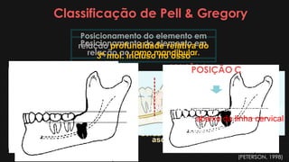 Classificação de Pell & Gregory
Posicionamento do elemento em
relação ao ramo mandibular.
CLASSE I
A coroa, em seu diâmetro mesio
distal, está completamente à frente da
borda anterior do ramo ascendente.
CLASSE II
Quando o dente estiver
parcialmente dentro do ramo.
CLASSE III
Quando o dente estiver localizado
completamente dentro do ramo
ascendente da mandíbula.
Posicionamento do elemento em
relação profundidade relativa do
3º mol. incluso no osso
POSIÇÃO A
Acima do plano oclusal ou na
mesma linha do segundo molar.
POSIÇÃO B
A posição mais alta do dente
incluso encontra-se abaixo do plano
oclusal e acima da linha cervical do
2 mol.
POSIÇÃO C
A posição mais alta do dente incluso
encontra-se abaixo da linha cervical
do segundo molar.
(PETERSON, 1998)
 