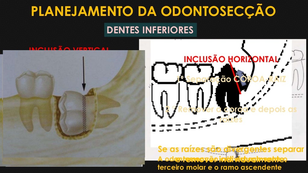 DENTES INCLUSOS E IMPACTADOS