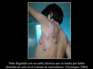 Niño flagelado con un cable eléctrico por su madre por haber
obtenido un cero en el examen de matemáticas. (Nicaragua, 2004)
 