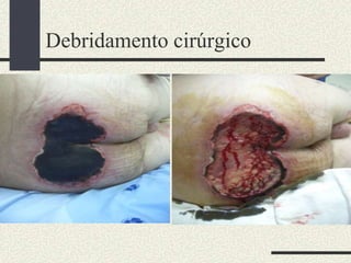Debridamento cirúrgico
 