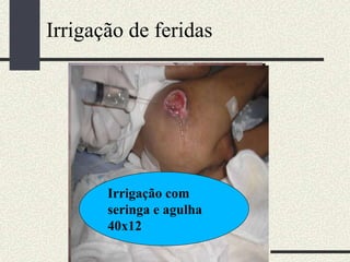 Irrigação com
bulbo da seringa
Irrigação com soro
Irrigação com
seringa e agulha
40x12
Irrigação de feridas
 