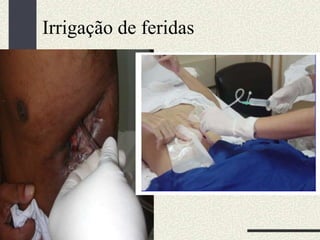 Irrigação de feridas
 