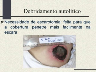 Debridamento autolítico
Necessidade de escarotomia: feita para que
a cobertura penetre mais facilmente na
escara
 