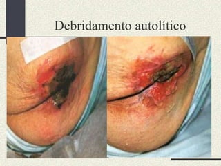 Debridamento autolítico
 