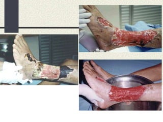 tratamento-de-feridas.ppt