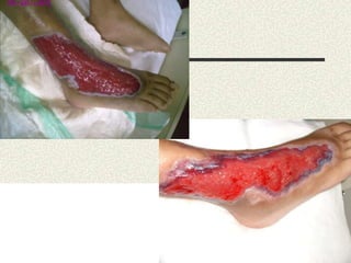 tratamento-de-feridas.ppt