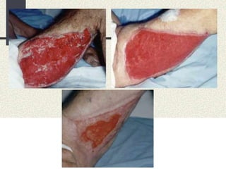 tratamento-de-feridas.ppt