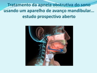 Tratamento da apneia obstrutiva do sono
usando um aparelho de avanço mandibular...
estudo prospectivo aberto
 