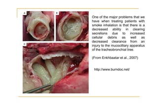 One of the major problems that we
have when treating patients with
smoke inhalation is that there is a
decreased ability in clearing
secretions due to increased
cellular debris as well as
decreased clearance from an
injury to the mucocilliary apparatus
of the tracheobronchial tree.

(From Enkhbaatar et al., 2007)


 http://www.burndoc.net/
 