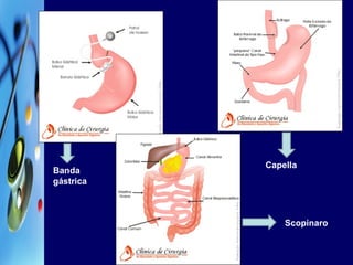 Capella Scopinaro Banda gástrica 