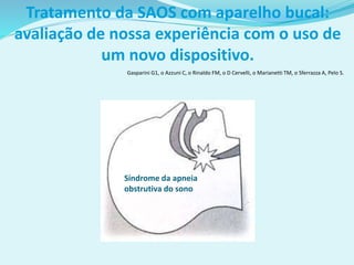 Gasparini G1, o Azzuni C, o Rinaldo FM, o D Cervelli, o Marianetti TM, o Sferrazza A, Pelo S.
Tratamento da SAOS com aparelho bucal:
avaliação de nossa experiência com o uso de
um novo dispositivo.
Síndrome da apneia
obstrutiva do sono
 