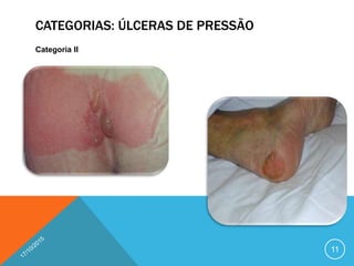 CATEGORIAS: ÚLCERAS DE PRESSÃO
Categoria II
11
 