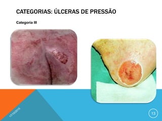 CATEGORIAS: ÚLCERAS DE PRESSÃO
Categoria III
13
 