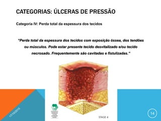 CATEGORIAS: ÚLCERAS DE PRESSÃO
Categoria IV: Perda total da espessura dos tecidos
“Perda total da espessura dos tecidos com exposição óssea, dos tendões
ou músculos. Pode estar presente tecido desvitalizado e/ou tecido
necrosado. Frequentemente são cavitadas e fistulizadas.”
14
 