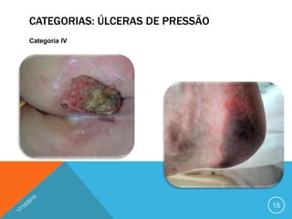 CATEGORIAS: ÚLCERAS DE PRESSÃO
Categoria IV
15
 