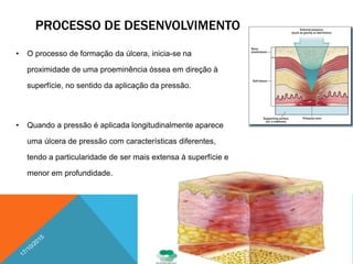 PROCESSO DE DESENVOLVIMENTO
• O processo de formação da úlcera, inicia-se na
proximidade de uma proeminência óssea em direção à
superfície, no sentido da aplicação da pressão.
• Quando a pressão é aplicada longitudinalmente aparece
uma úlcera de pressão com características diferentes,
tendo a particularidade de ser mais extensa à superfície e
menor em profundidade.
19
 