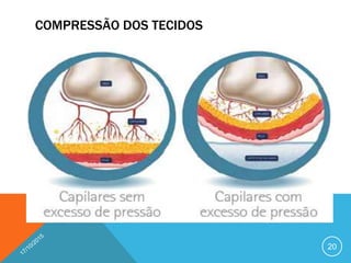 COMPRESSÃO DOS TECIDOS
20
 
