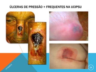 ÚLCERAS DE PRESSÃO + FREQUENTES NA UCIPSU
24
 