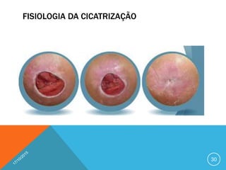 FISIOLOGIA DA CICATRIZAÇÃO
30
 