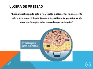 ÚLCERA DE PRESSÃO
“Lesão localizada da pele e / ou tecido subjacente, normalmente
sobre uma proeminência óssea, em resultado da pressão ou de
uma combinação entre esta e forças de torção.”
6
 
