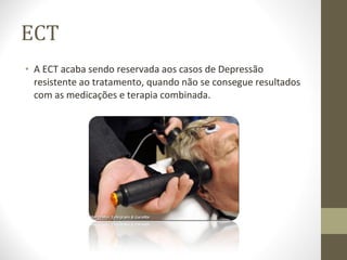 ECT A ECT acaba sendo reservada aos casos de Depressão resistente ao tratamento, quando não se consegue resultados com as medicações e terapia combinada. 