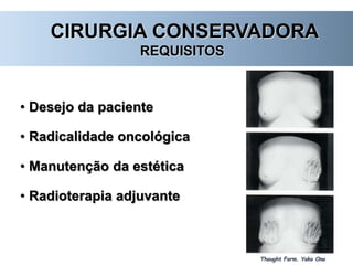 CIRURGIA CONSERVADORA
REQUISITOS
• Desejo da paciente
• Radicalidade oncológica
• Manutenção da estética
• Radioterapia adjuvante
Thought Form. Yoko Ono
 