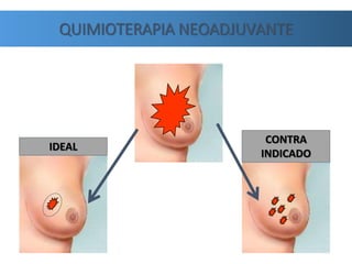 QUIMIOTERAPIA NEOADJUVANTE
IDEAL
CONTRA
INDICADO
 