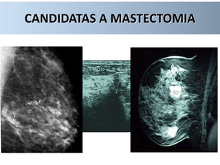 CANDIDATAS A MASTECTOMIA
 