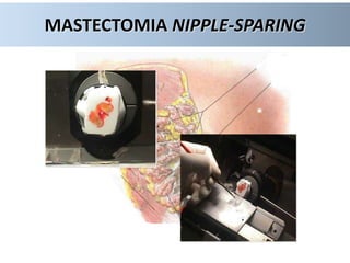MASTECTOMIA NIPPLE-SPARING
 