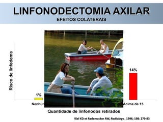 LINFONODECTOMIA AXILAR
EFEITOS COLATERAIS
1%
7%
14%
Nenhum 1 a 10 Acima de 15
Riscodelinfedema
Quantidade de linfonodos retirados
Kiel KD et Rademacker AW, Radiology , 1996; 198: 279-83
 