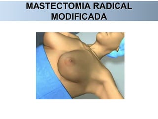 MASTECTOMIA RADICAL
MODIFICADA
 
