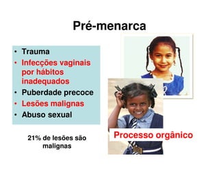 Pré-menarca
• Trauma
• Infecções vaginais
por hábitos
inadequados
• Puberdade precoce
• Lesões malignas
• Abuso sexual
21% de lesões são
malignas
Processo orgânico
 