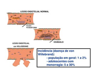 COÁGULO
PLACA
PLAQUETÁRIA
LESÃO ENDOTELIAL NORMAL
LESÃO ENDOTELIAL
von WILLEBRAND
PLAQUETA
FIBRINA
Incidência (doença de von
Willebrand):
- população em geral: 1 a 2%
- adolescentes com
menorragia: 5 a 30%
 
