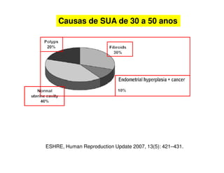 ESHRE, Human Reproduction Update 2007, 13(5): 421–431.
Causas de SUA de 30 a 50 anos
 