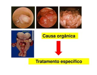 Causa orgânica
Tratamento específico
 