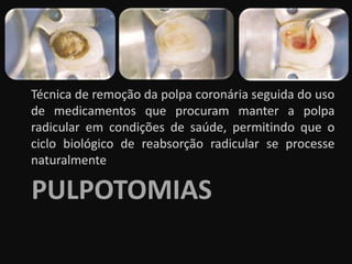 Técnica de remoção da polpa coronária seguida do uso
de medicamentos que procuram manter a polpa
radicular em condições de saúde, permitindo que o
ciclo biológico de reabsorção radicular se processe
naturalmente

PULPOTOMIAS
 