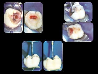 Endodontia Em Dentes Deciduos