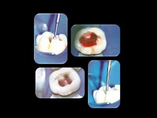 Endodontia Em Dentes Deciduos