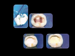 Endodontia Em Dentes Deciduos