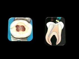 Endodontia Em Dentes Deciduos