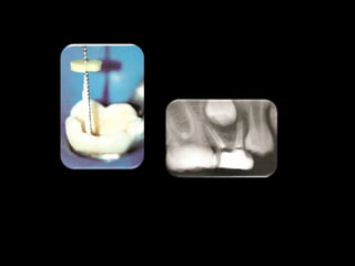 Endodontia Em Dentes Deciduos